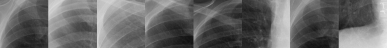 Top-activating patches: costophrenic angle / lung base