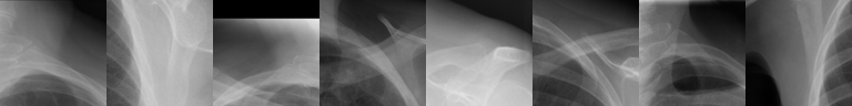 Top-activating patches: clavicle and shoulder
